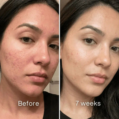 Dermatologic Acne Scar Repair Stick™