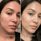 Dermatologic Acne Scar Repair Stick™