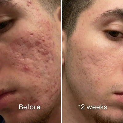Dermatologic Acne Scar Repair Stick™