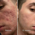 Dermatologic Acne Scar Repair Stick™